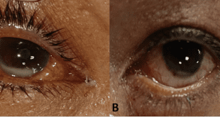 Both eyes' infection by Klebsiella pneumoniae.