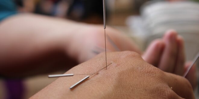 acupuncture