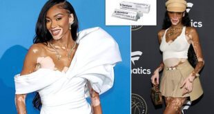 Winnie Harlow receives £1,000 cream approval for vitiligo.