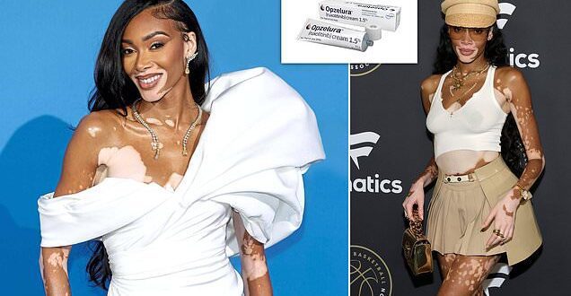 Winnie Harlow receives £1,000 cream approval for vitiligo.